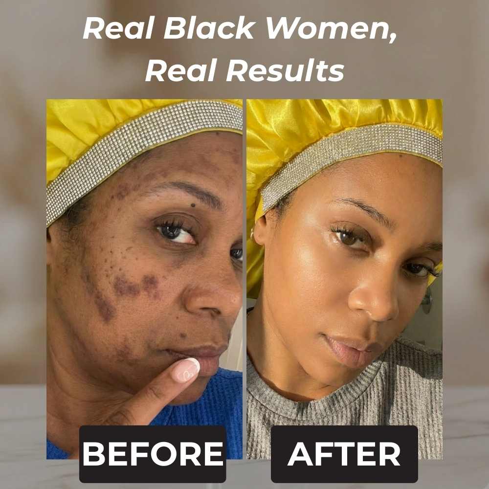 Rennora Dark Spot Remover