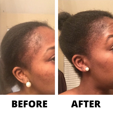 Rennora EXTRA-Strength Hair Growth Serum