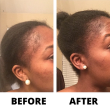 Load image into Gallery viewer, Three Bottles of Rennora EXTRA-Strength Hair Growth Serum